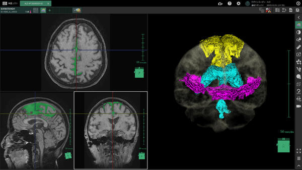 脳脊髄液腔の各領域の抽出例 黄色：高位円蓋部・正中のくも膜下腔，水色：脳室，赤紫色：シルビウス裂・脳底槽