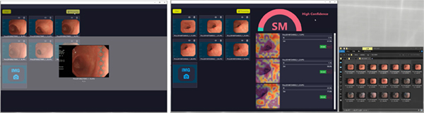 早期胃癌AI診断支援システム デモ画像