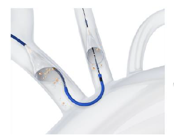 SENTINEL Cerebral Protection System