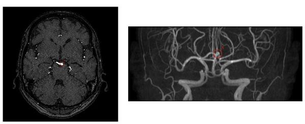 脳底動脈の検出事例