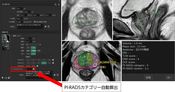 前立腺ビューでの読影支援機能。 腫瘍計測をすると，自動で腫瘍のサイズ/区域/側性などを表示する。 また，医師が選択した各画像スコアに基づき，PI-RADSカテゴリーを自動算出する。