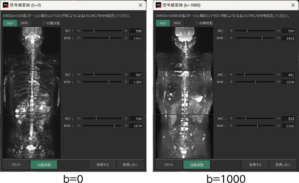Body DWIビュー（MR）での自動スティッチング機能および自動信号値補正機能。