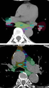 肺癌取り扱い規約（第8版）によるラベリング