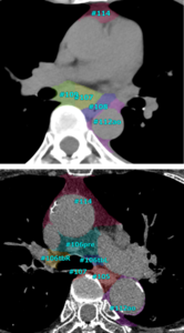 食道癌取り扱い規約（第12版）によるラベリング