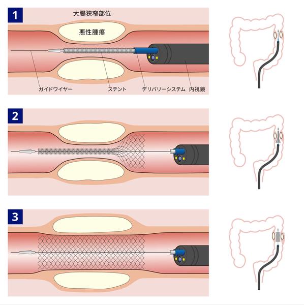 ステント展開イメージ
