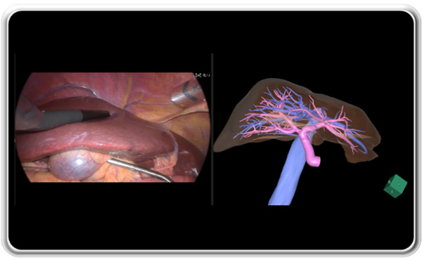 肝臓3D画像連動AI技術