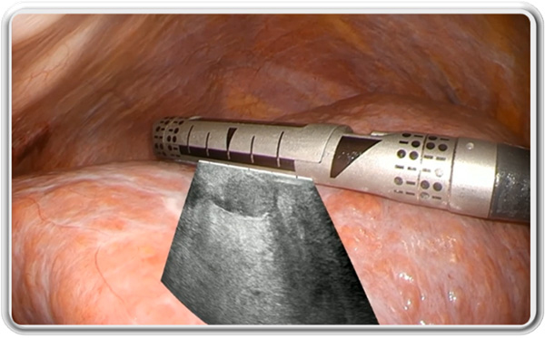 超音波画像重畳AI技術