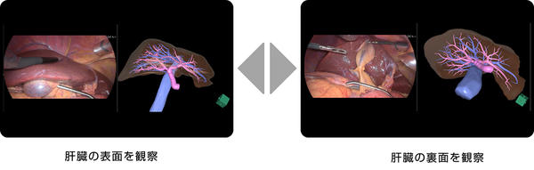 手術中の内視鏡映像から肝臓の向きを解析し，事前に作成した肝臓の3D画像を内視鏡映像にあわせて表面や裏面を観察している様子