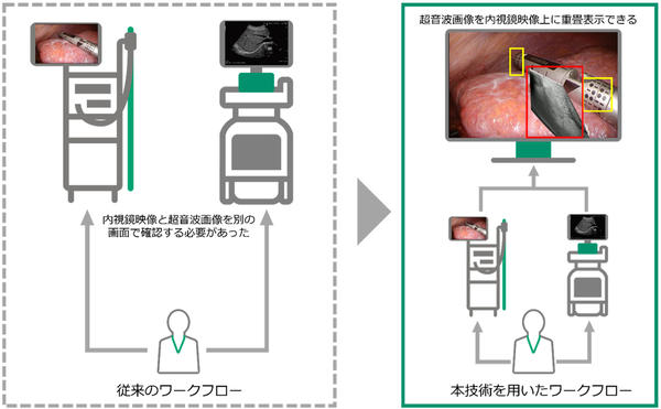 術中超音波検査中に，内視鏡映像と超音波画像を別の画面で確認する従来のワークフローと，超音波画像を内視鏡映像上に重畳表示する本技術を用いたワークフローを比較した様子