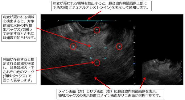 超音波内視鏡検査において，富士フイルムが開発したソフトウェアが，膵臓が存在すると推定される領域および膵充実性病変が疑われる領域を検出する様子