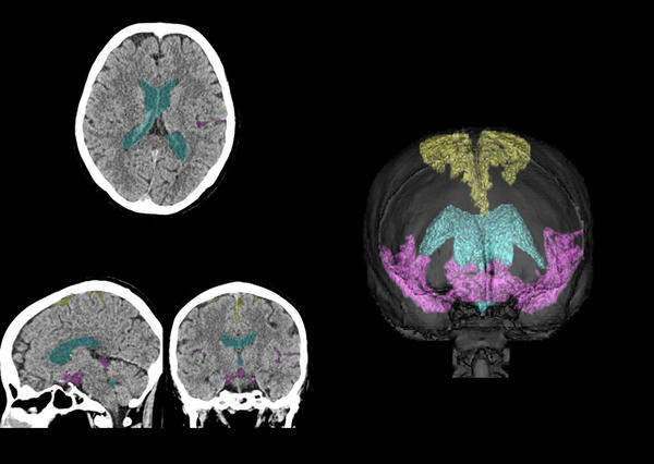CT画像上で本技術を用いて脳脊髄液腔の各領域を抽出した例