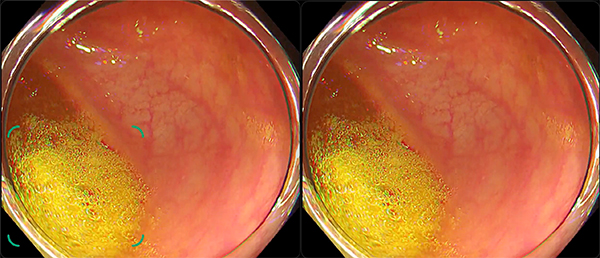 残渣による偽陽性が改善した例