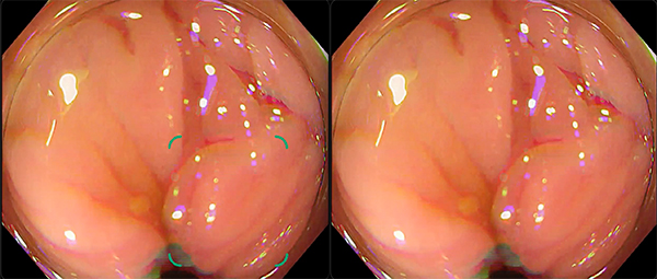 ひだによる偽陽性が改善した例
