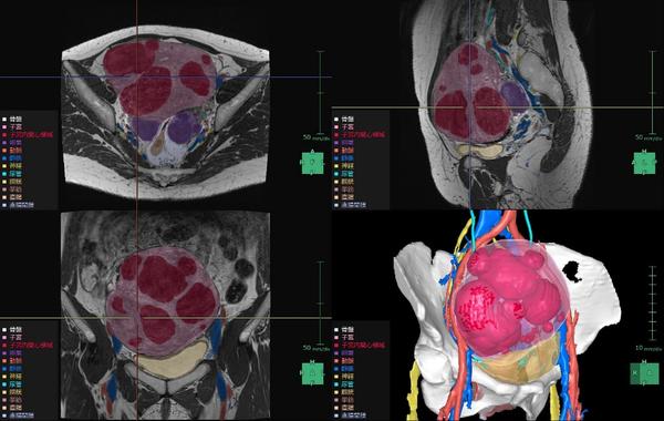 婦人科臓器解析の解析画面