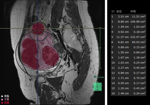 婦人科臓器解析の解析画面