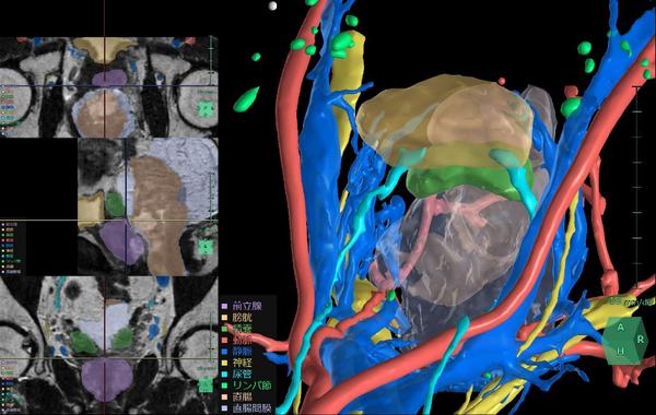 膀胱周辺臓器解析の解析画面