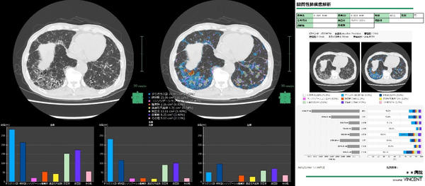 間質性肺疾患解析画面・レポート