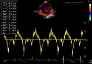 AIが血流を自動解析