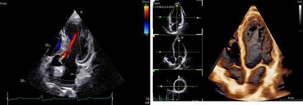 次世代の画像エンジンによる高精細な心臓画像