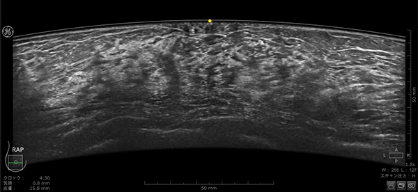 Invenia ABUS Premium で収集された乳房画像（乳頭直下「図黄色点」が描出されている）
