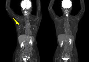 （PET画像）　　左：照射前　右：照射後