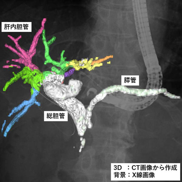 ERCP中に撮影したX線透視画像上にCT画像を用いて作成した胆管・膵管3D像を重畳表示している様子