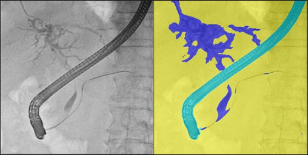 胆管領域を検出しコントラストを強調した様子（右画像）