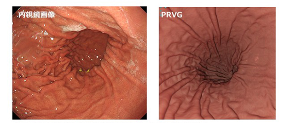 図2．内視鏡画像と写実的仮想胃内視鏡（PRVG）との比較 PRVGをVRゴーグルで観察することで内視鏡ではできない立体での観察が可能