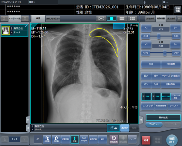 「CXR Finding-i 気胸検出タイプ」により解析された気胸の検出領域を表示