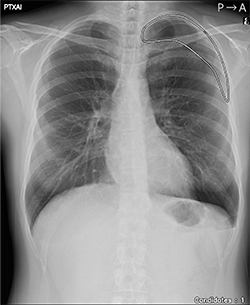 気胸の検出領域を表示