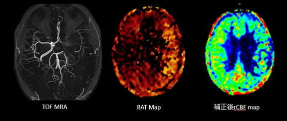 左 MCA血行再建術後症例