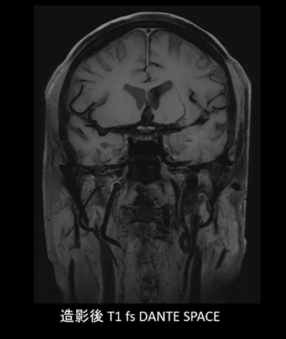 動脈硬化性病変のリスク評価や，脳卒中再発リスクの層別化に貢献する DANTE 血液信号抑制技術