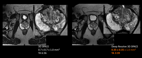 3D撮像に新たに対応した独自の画像再構成技術Deep Resolveにより，微小病変の描出や腫瘍の境界を明瞭化
