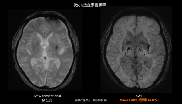 撮像時間を大幅に短縮しながら高分解能な磁化率強調画像を取得するWave-CAIPI SWI技術
