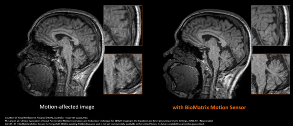BioMatrix Motion Sensorにより，被検者の動きによる画質劣化を抑制し，安定したMPRAGE撮像を実現