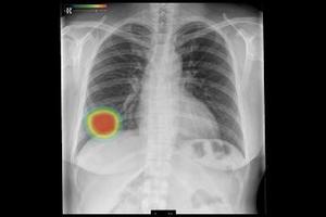 胸部X線CADサービス*6