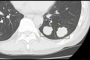 肺結節検出サービス*7