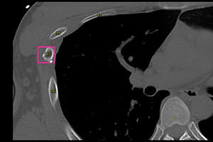 肋骨骨折検出サービス*8