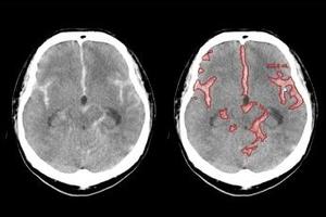 頭部高吸収／低吸収強調フィルタサービス*9