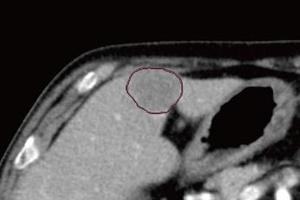 腹部吸収値強調フィルタサービス*10