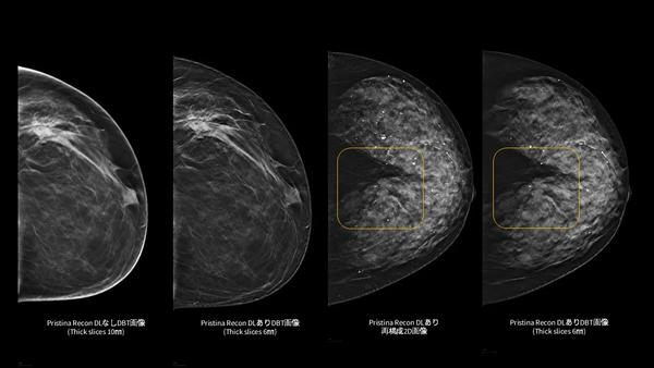 「Pristina Recon DL」で3Dマンモグラフィの視認性を向上