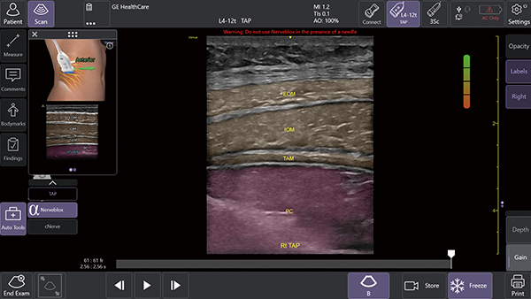 Nervebloxによる神経ブロックのサポート（中央）Anatomical Labeling：画像上に解剖学的ラベルを略語形式で表示 （右上）Quality Meter：表示画像の品質をリアルタイムで評価して色分け表示