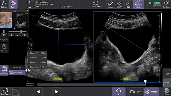 Auto Bladder Volumeにより2断面から半自動的に膀胱容積を計算