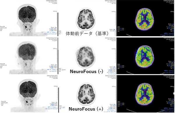 頭部体動補正機能の効果 上段：体動前データ，中段：NeuroFocus（-)，下段：NeuroFocus（+） 画像提供：さいたまセントラルクリニック