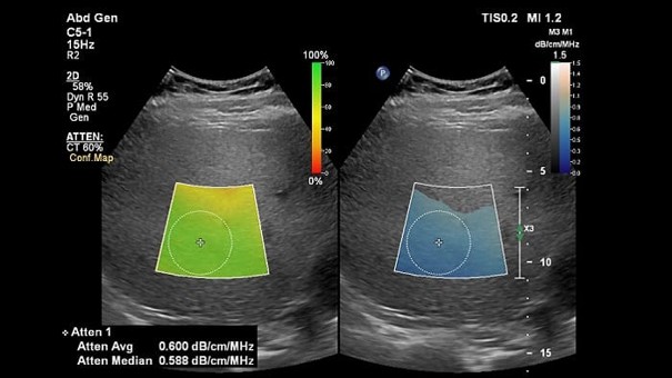 減衰イメージング「Attenuation Imaging」機能