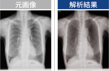 骨信号減弱機能イメージ