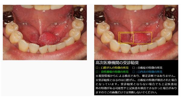 「口腔粘膜画像解析システム Mucosight AI」での解析結果のイメージ