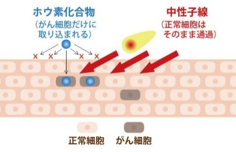 ▲BNCTのメカニズム