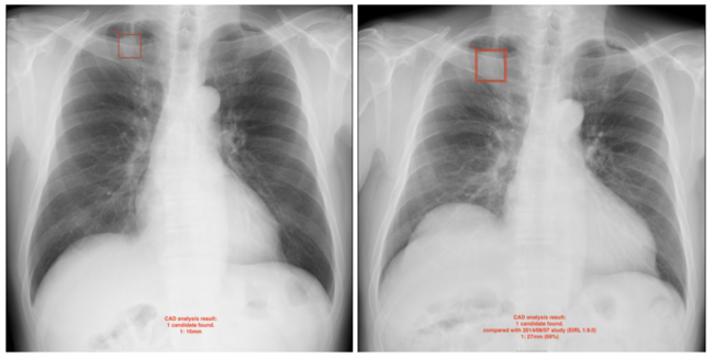 過去画像（左）と比較して肺結節候補域の増加を示した例