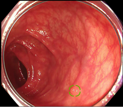 大腸ポリープ候補の四隅を囲むボックスが表示される。